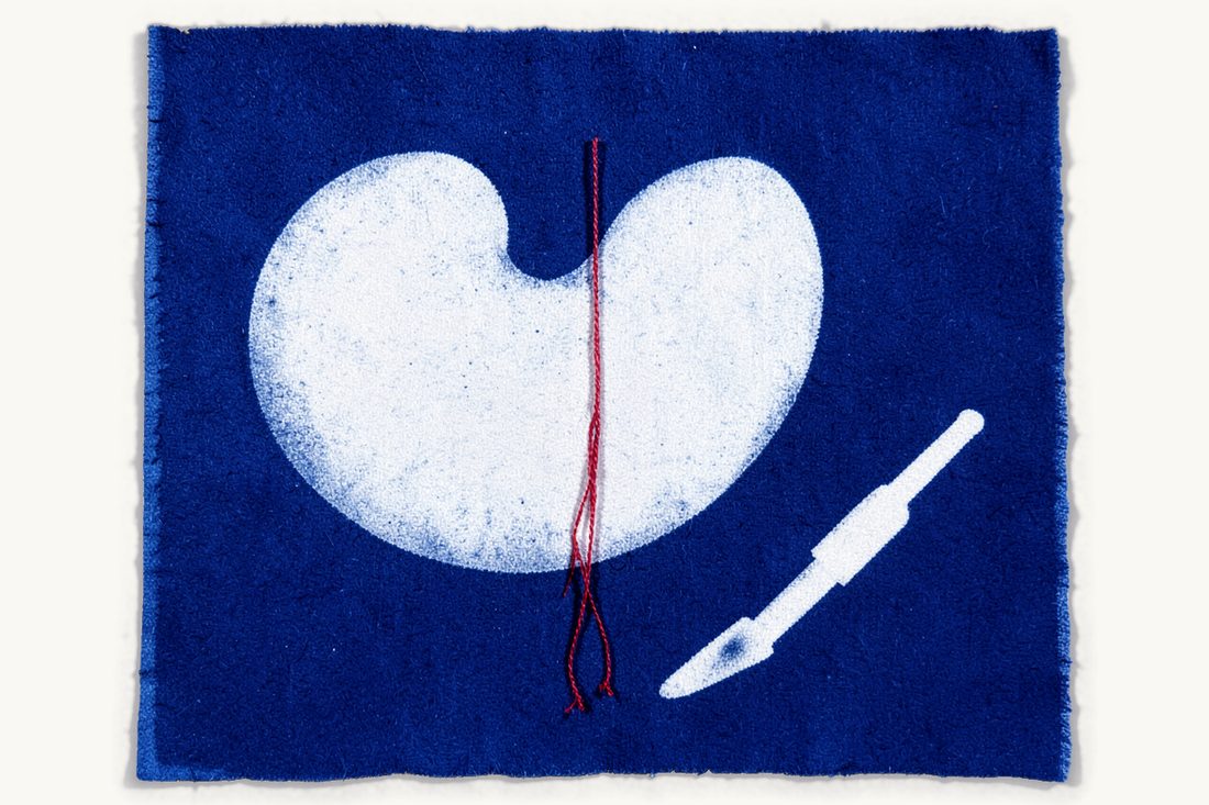 Botched gastric sleeve and bariatric claims: a large stomach silhouette with a red thread seam coming undone at the bottom, a scalpel beside it, cyanotype print